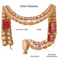 IBS and Crohns are related to gut bacteria and low Vitamin D and are auto immune diseases