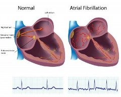 AFIB is different from whats normal heart rate variability